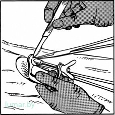 Зажим для проведения обрезания, диам. 12 мм